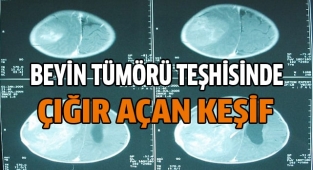 Beyin tümörü teşhisinde çığır açıldı