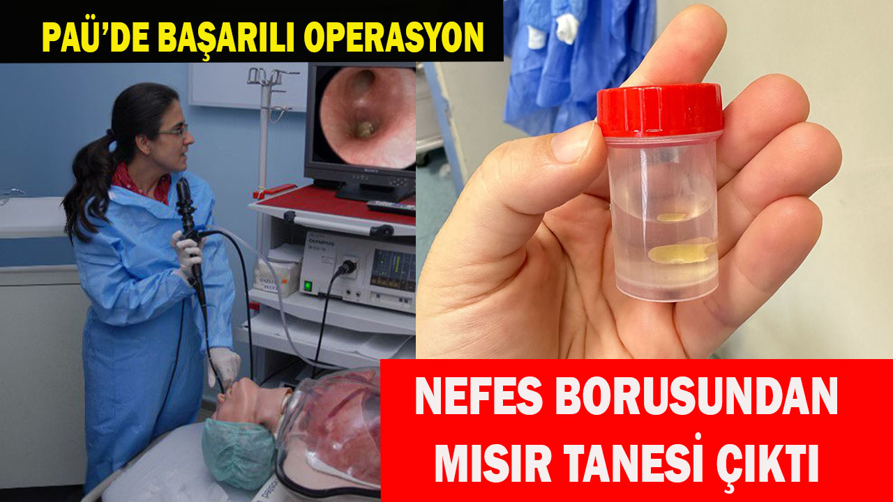 Nefes borusuna kaçan mısır tanesi çıkarıldı