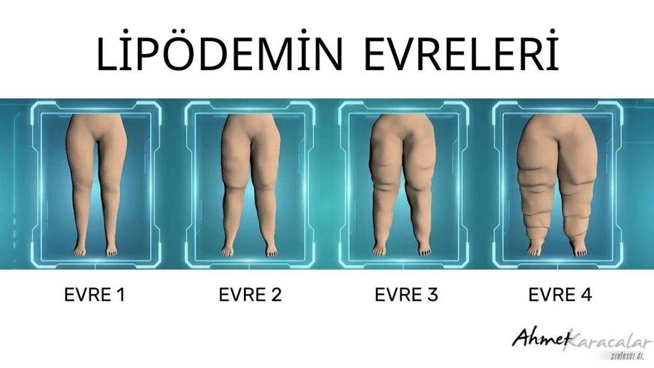 KİLO VEREMİYORSANIZ SUÇLU İRADENİZ DEĞİL, LİPÖDEM OLABİLİR