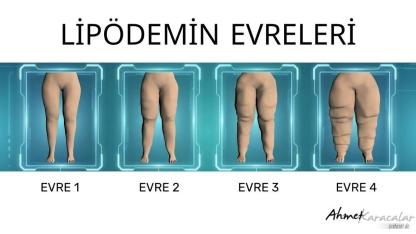 KİLO VEREMİYORSANIZ SUÇLU İRADENİZ DEĞİL, LİPÖDEM OLABİLİR